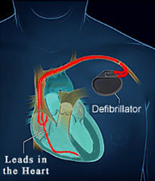 Defibrillator ICD Implant